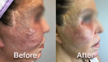 Stem Cell Skin Rejuvenation